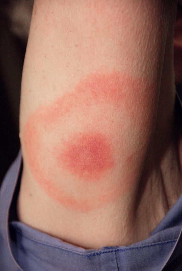 Lyme_rash